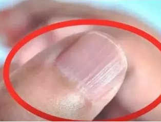向日葵视频色版下载厂家分析手指甲有竖纹的根本原因 向日葵视频色版下载厂家分析手指甲有竖纹的根本原因